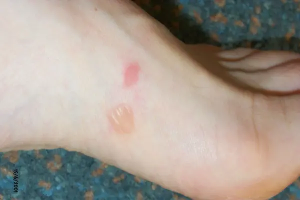skin-on-skin friction