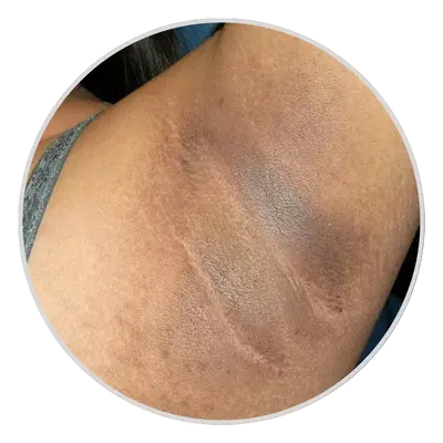 Acanthosis Nigricans