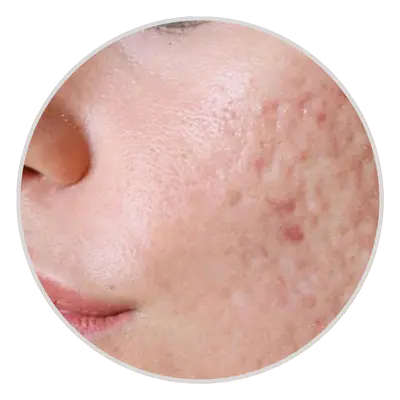Acne Scars
