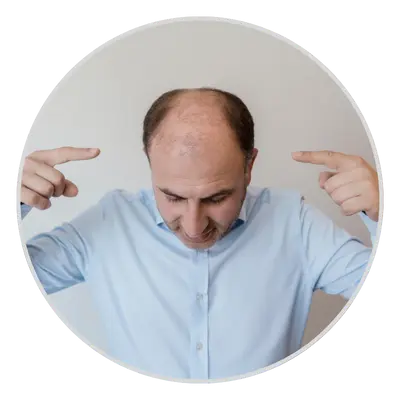 Baldness