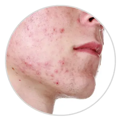 Blackheads