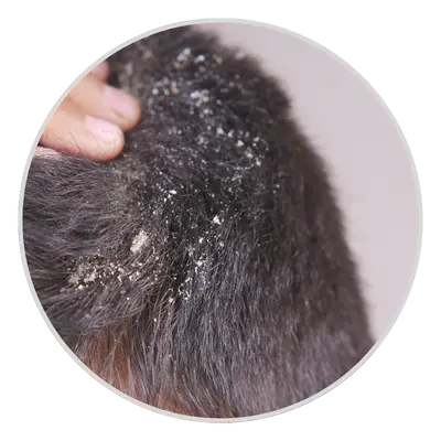 Dandruff