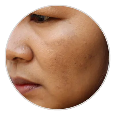 Dull skin