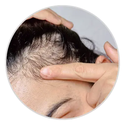 Increased Hair Shedding