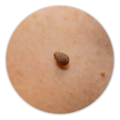 Pedunculated Skin Tags