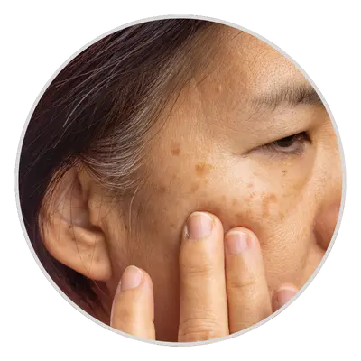 Pigmentation