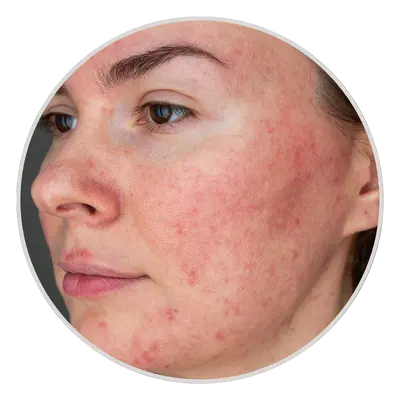 Rosacea