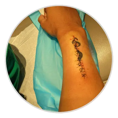 Surgical Excision for tattoo removal