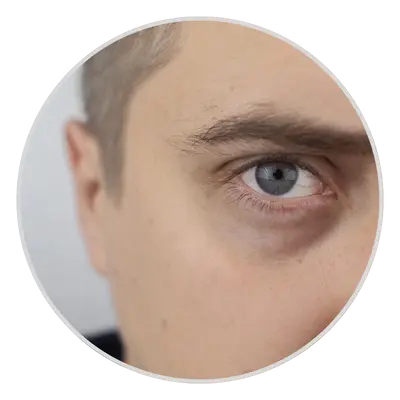 Swollen Under-Eyes