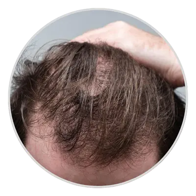 Telogen Effluvium