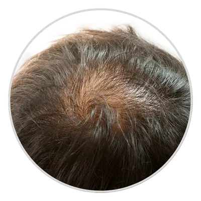 Thinning at the Crown area