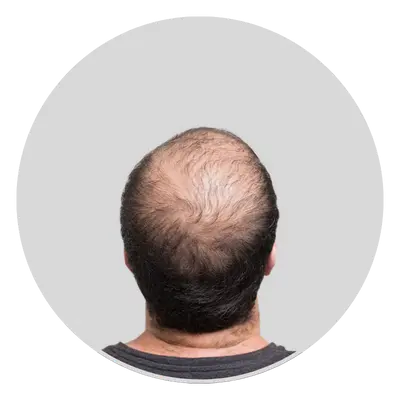 Thinning or Bald Patches
