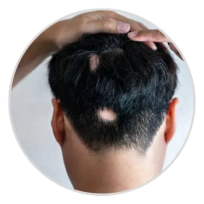 Traction Alopecia