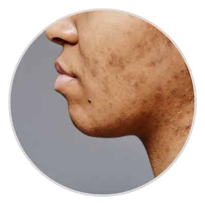 Acne Scars