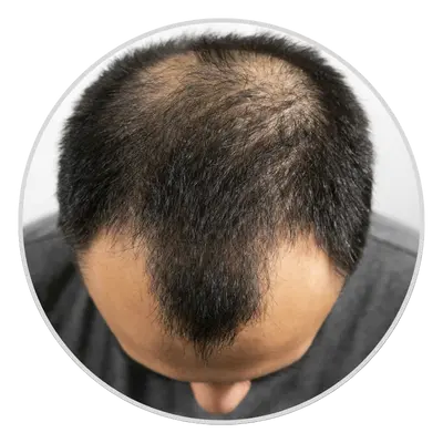 Androgenetic Alopecia