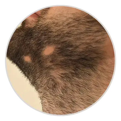 Beard Hair Loss