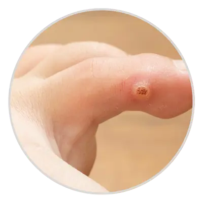 Black Dots Inside the Wart