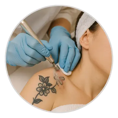 Dermabrasion for tattoo removal