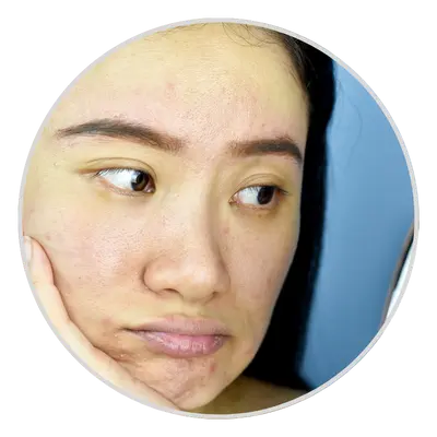 Dull skin