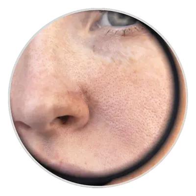 Enlarged Pores