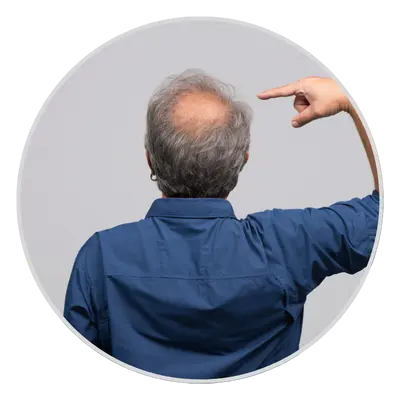Family History of Hair Loss