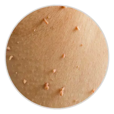 Flesh-Colored or Pigmented Tags