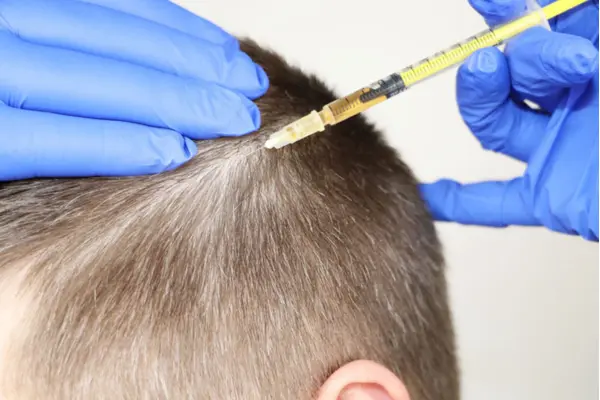 Mesotherapy for hair loss