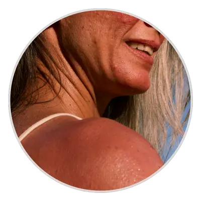 Sun Damage