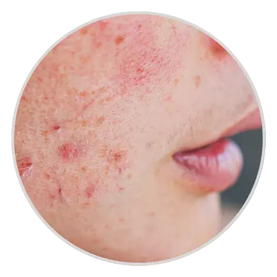 damaged skin