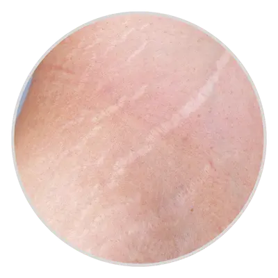 Stretch Marks