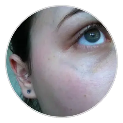 Age Spots