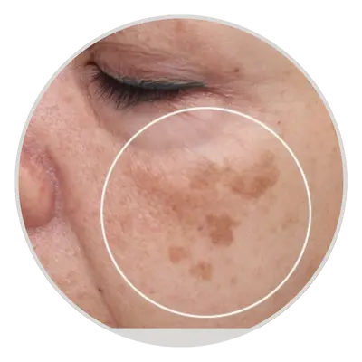 Age Spots