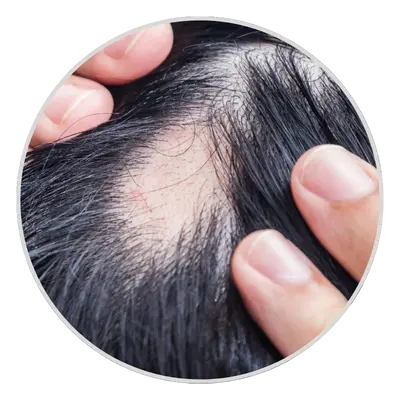 Bald Patches