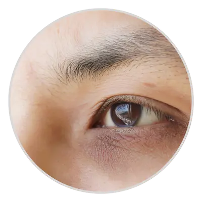 Dark Circles