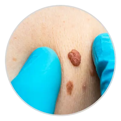 Inflamed Skin Tags