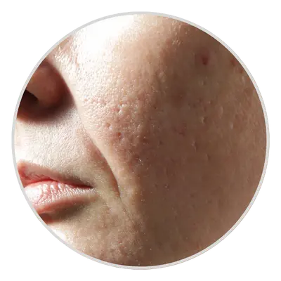 Large Pores