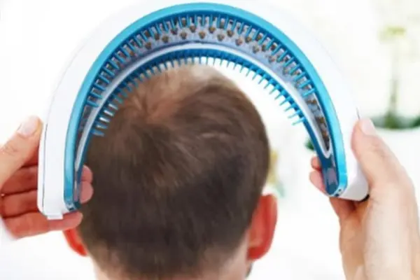 Low-Level Laser Therapy for hair loss