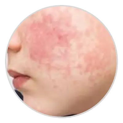 Severe Skin Sensitivity