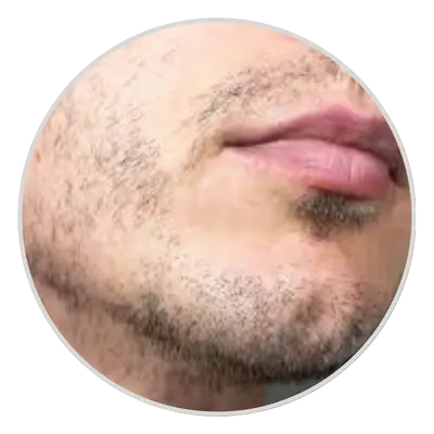 Thin or No Beard Growth