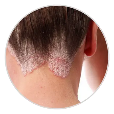 Tinea Capitis (Scalp Ringworm)