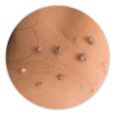 Clustered Skin Tags