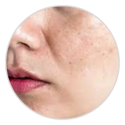 Dark Spots