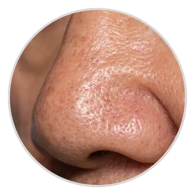 Enlarged Pores