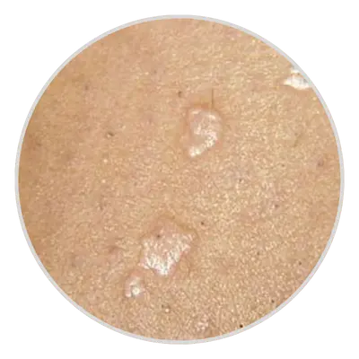 Flat or Smooth Warts