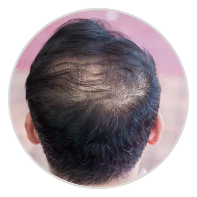 Hair Thinning