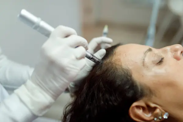 Microneedling for female hair loss