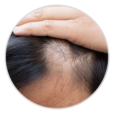 Patchy Bald Spots