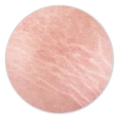 Stretch Marks