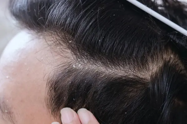 dandruff in men