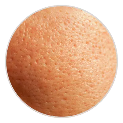 Enlarged Pores